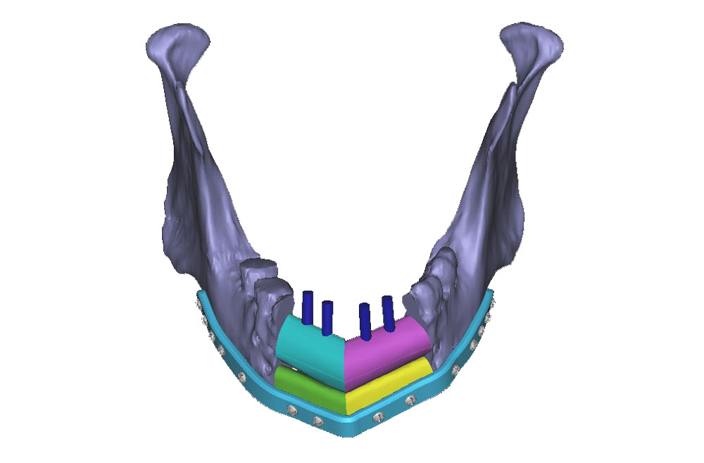VSP for Patient-Specific Reconstructive Microsurgery Case Study Figure 2
